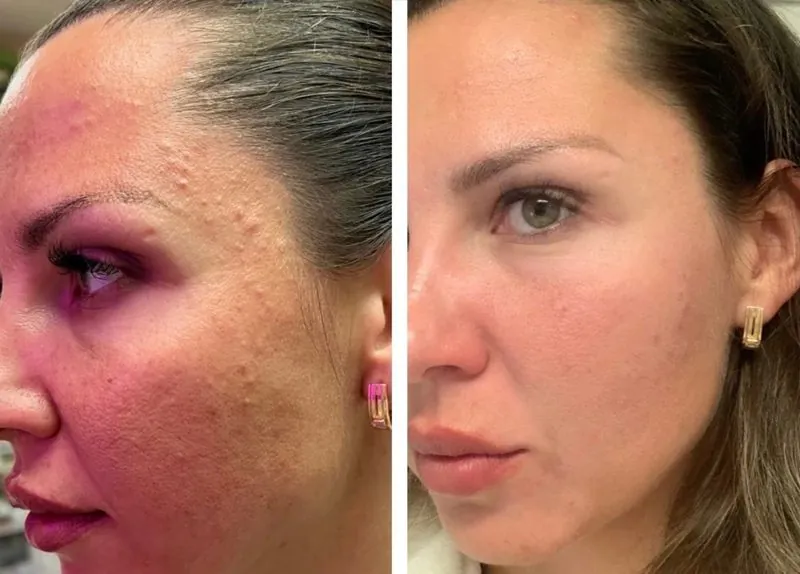 Before and after: acne and breakouts