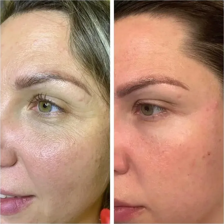 Before and after: fine lines and firmness