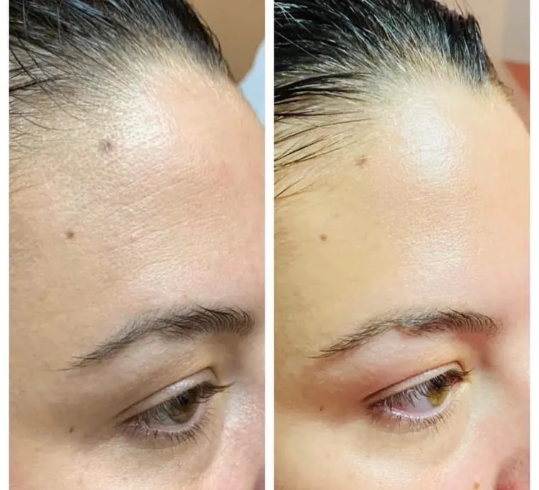 Before and after: texture and congestion