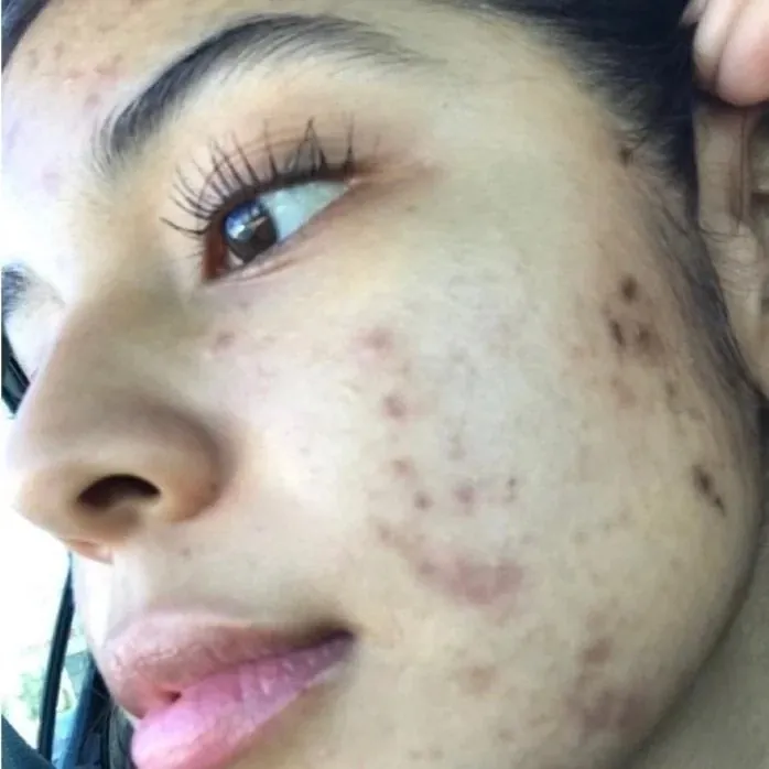 Skin showing acne and breakouts