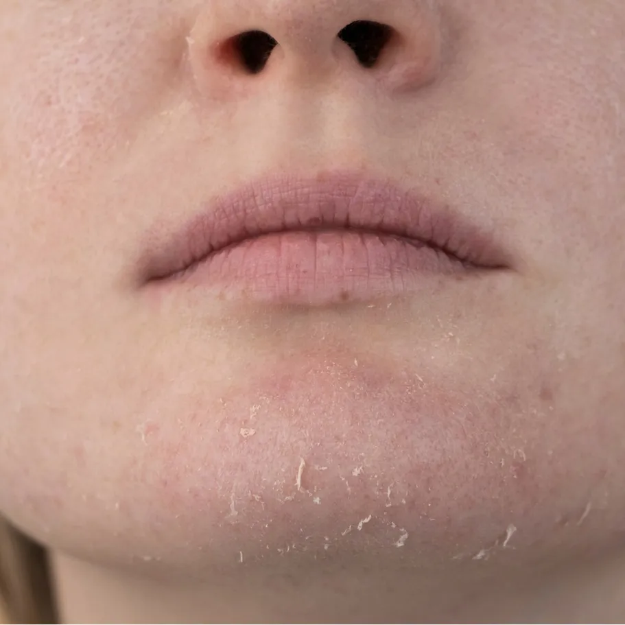 Skin showing dullness and dehydration