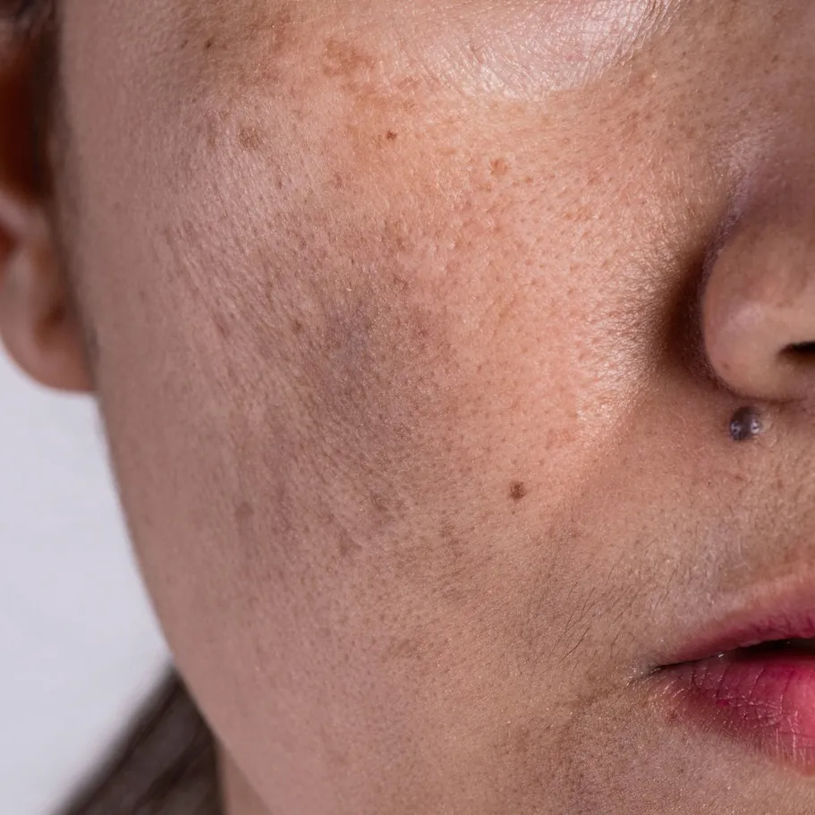 Skin showing pigmentation and sun damage