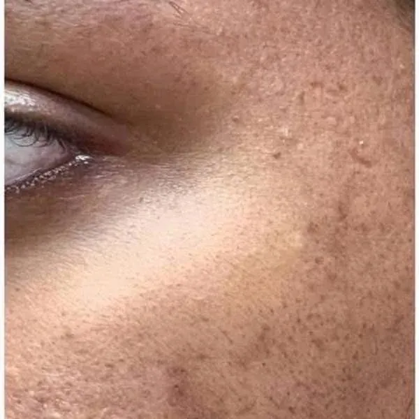 Skin showing pores, congestion and texture