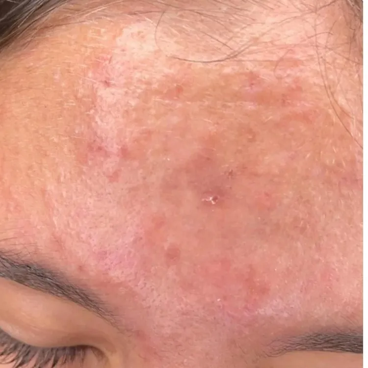 Skin showing sensitive skin